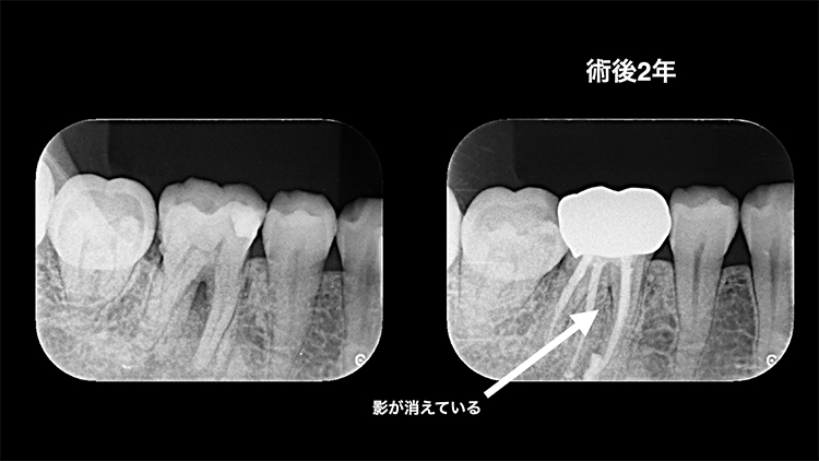 ジルコニアクラウン | 市ヶ谷・歯医者