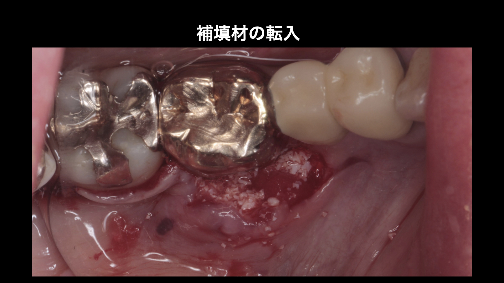 【50代女性】歯肉が腫れる状況を改善し骨、歯肉を再生させたケース | 市ヶ谷・歯医者