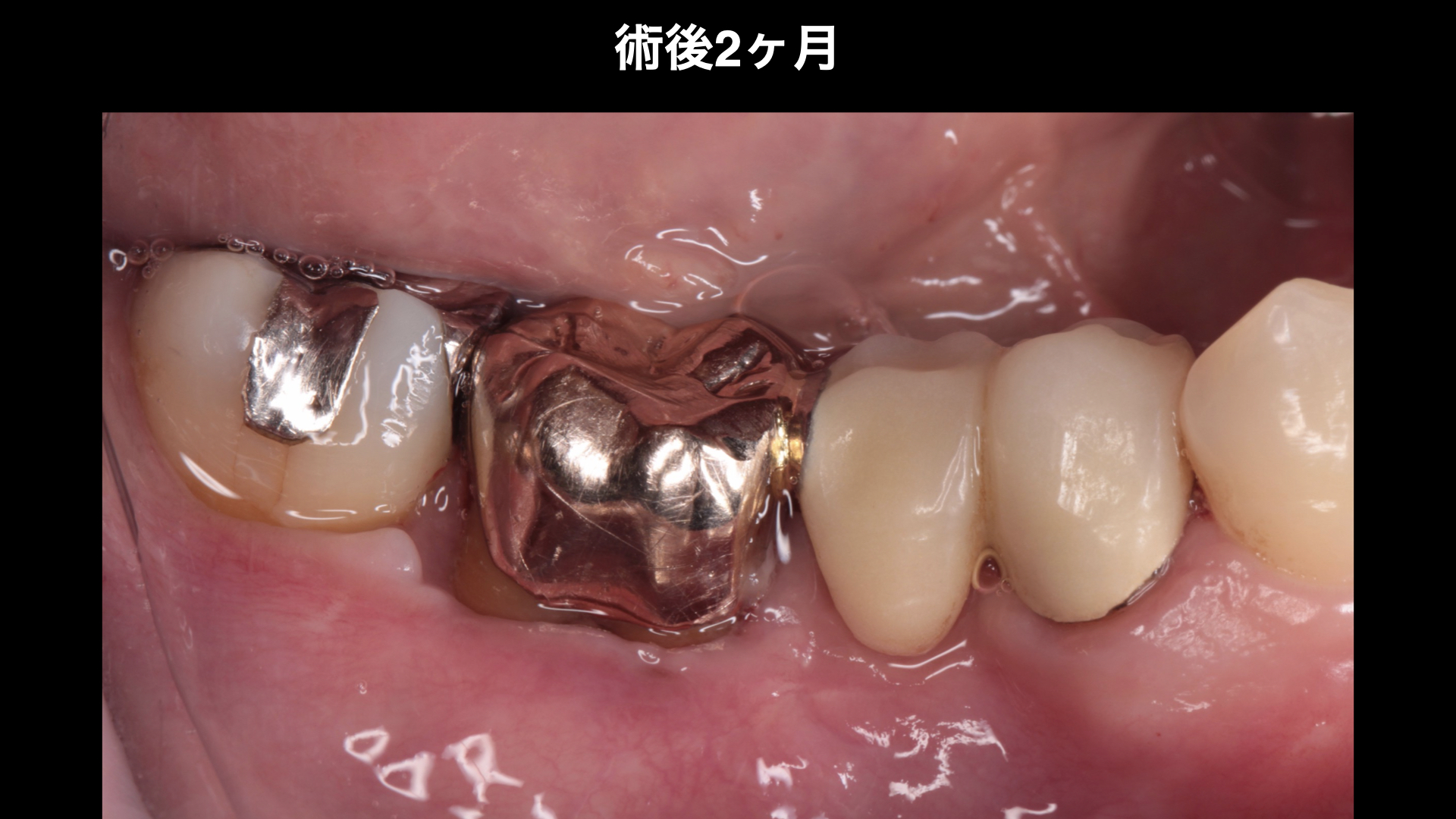 【50代女性】歯肉が腫れる状況を改善し骨、歯肉を再生させたケース | 市ヶ谷・歯医者