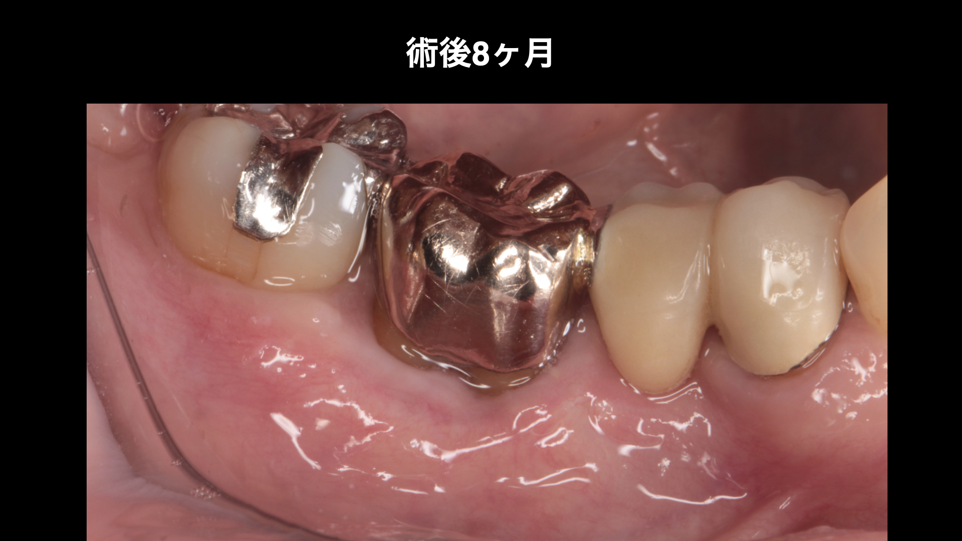 【50代女性】歯肉が腫れる状況を改善し骨、歯肉を再生させたケース | 市ヶ谷・歯医者
